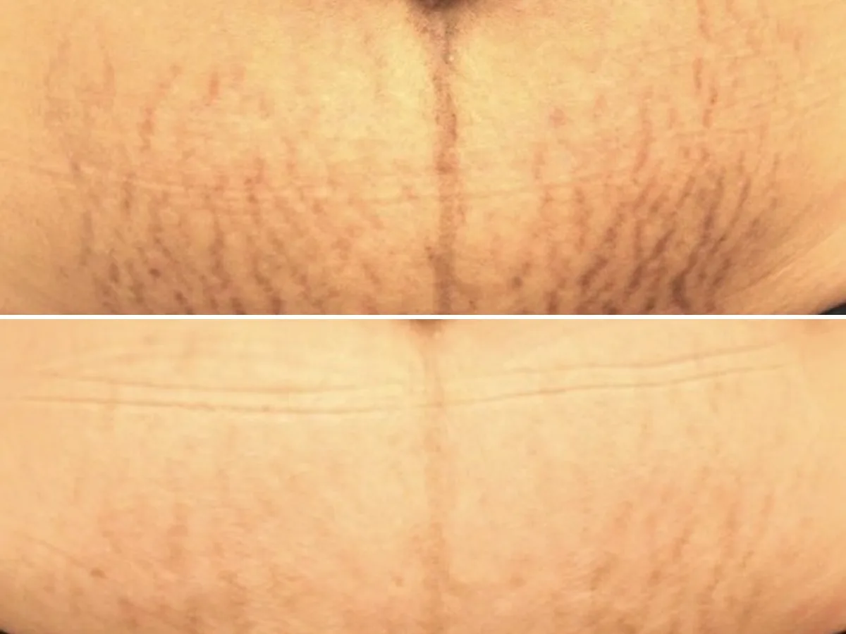Abdomen stretch-mark camouflage, before and after example