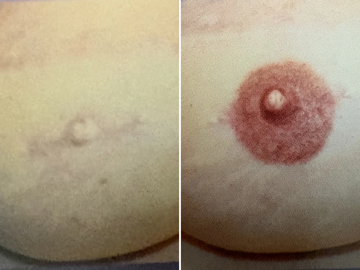 3D areola and nipple restoration, before and after example