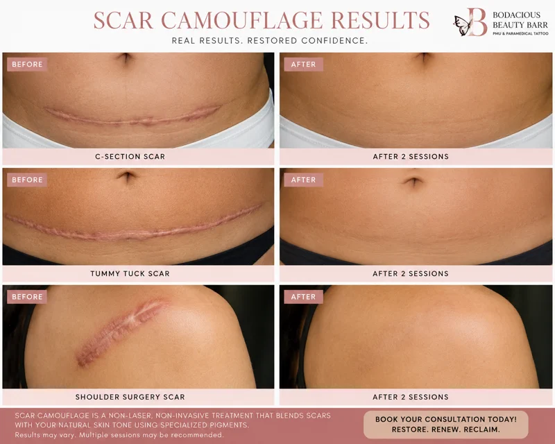 Client-supplied graphic with C-section, tummy-tuck and shoulder scar camouflage before-and-after examples